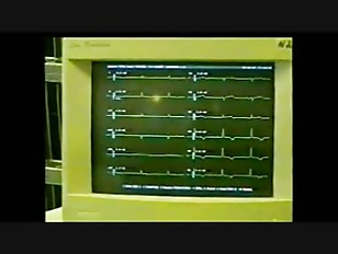 308px x 232px - heart surgery Porn Tube Videos at YouJizz